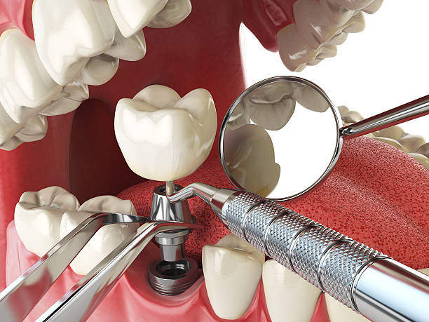 Best Emergency Tooth Extraction in Greeneville, TN